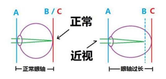 睫狀肌長期痙攣無法放松